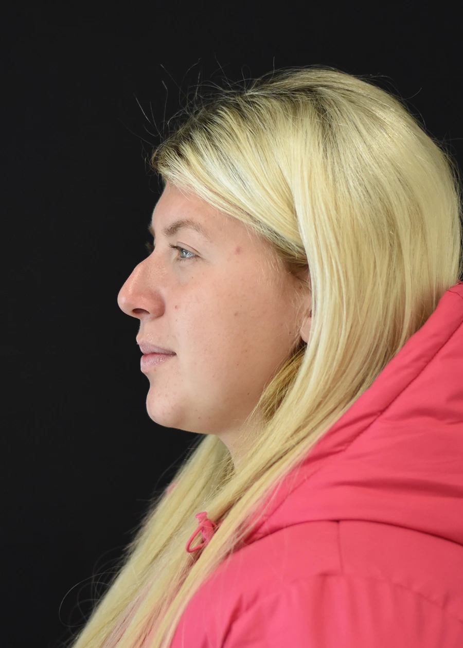 Rhinoplasty Patient 1 Set 2 Before