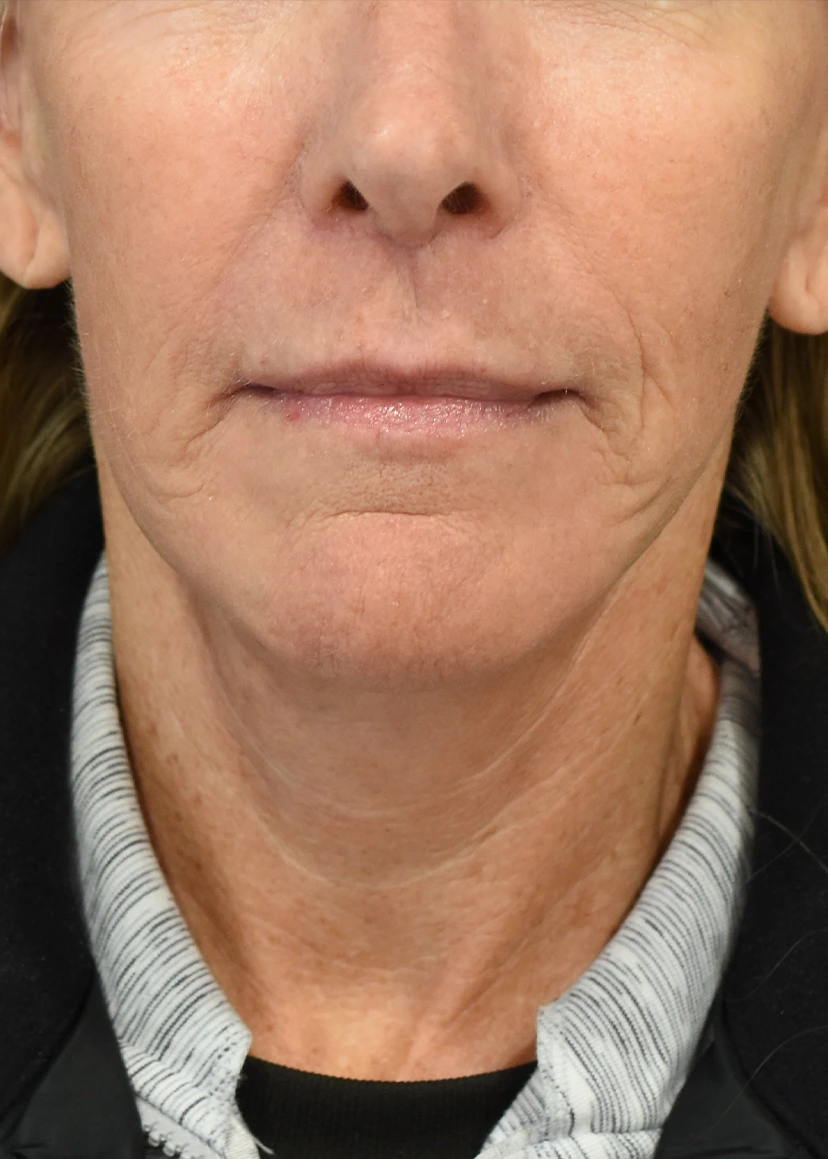 Deep Plane Facelift Patient 31 Set 1 After