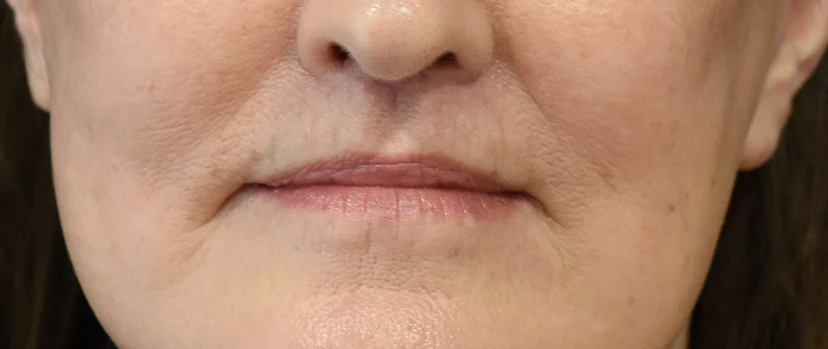 Lip Lift Patient 15 Set 1 After