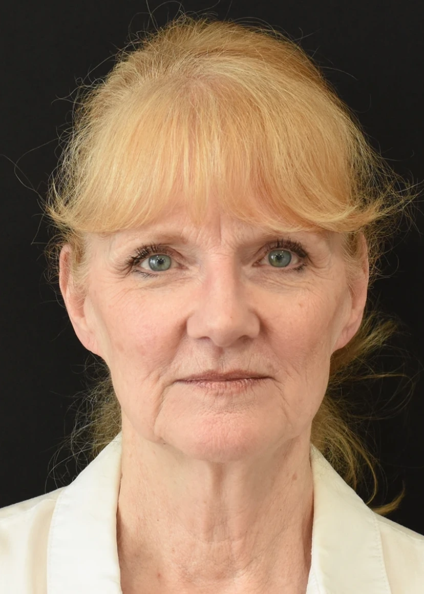 Deep Plane Facelift Patient 17 Set 1 Before